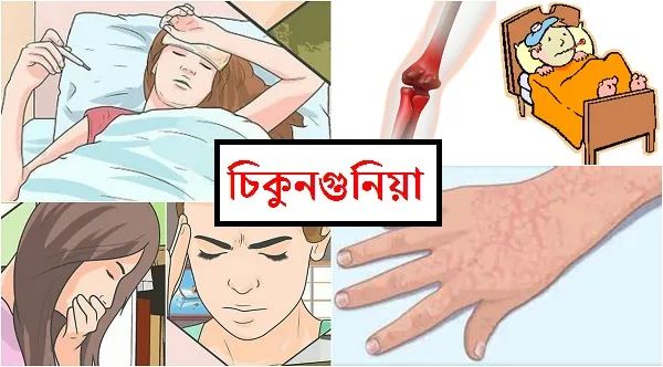 চিকুনগুনিয়া বিনামূল্যে চিকিৎসা