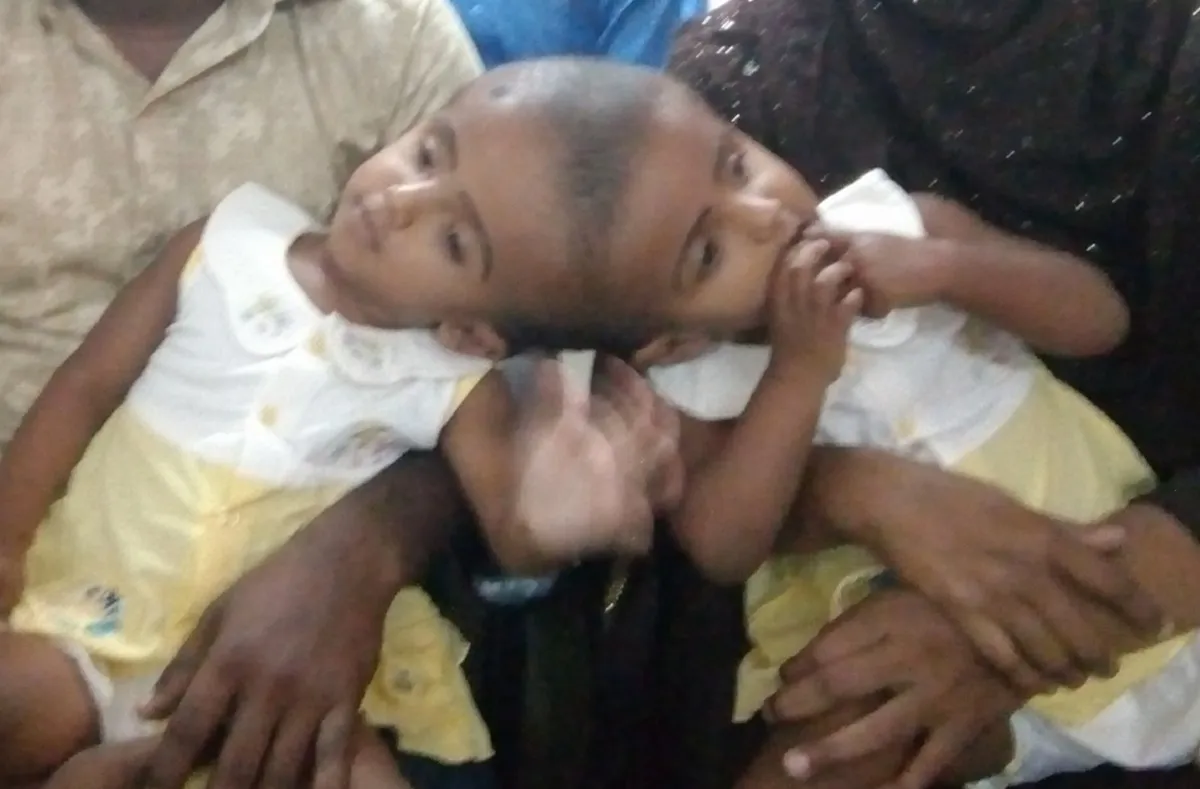 রাবেয়া-রোকাইয়ার ‘জটিল অস্ত্রোপচার’ তিন মাস পর
