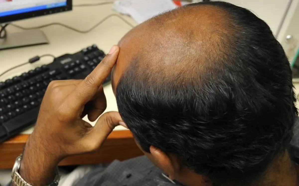 সাত ঘন্টার বেশি কাজে মাথায় টাক