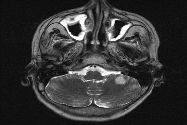 মস্তিষ্কের MRI স্ক্যান, কালো ছত্রাকের মতো দেখা যাচ্ছে. Channel i News - চ্যানেল আই নিউজ