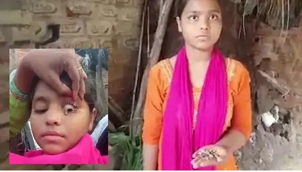 কিশোরীর চোখে পাথর বের করার জন্য চিকিৎসা করা হচ্ছে. Channel i News - চ্যানেল আই নিউজ