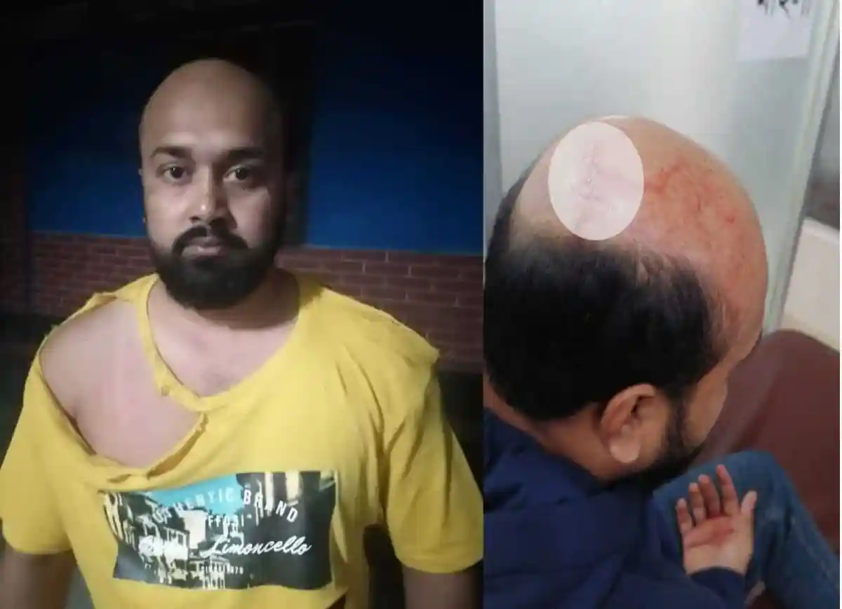প্রবাসীর মাথার চুল ক্ষত ও ক্ষতচিহ্ন, চ্যানেল আই অনলাইন. Channel i News - চ্যানেল আই নিউজ