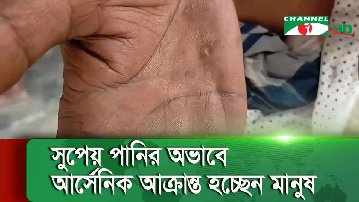 মেহেরপুরের মানুষের আর্সেনিক আক্রান্ত হাতের ছবি. Channel i News - চ্যানেল আই নিউজ