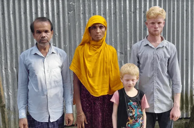 দুই ভাইয়ের সাদা চামড়ার সমস্যা নিয়ে মা-বাবার দুশ্চিন্তা. Channel i News - চ্যানেল আই নিউজ