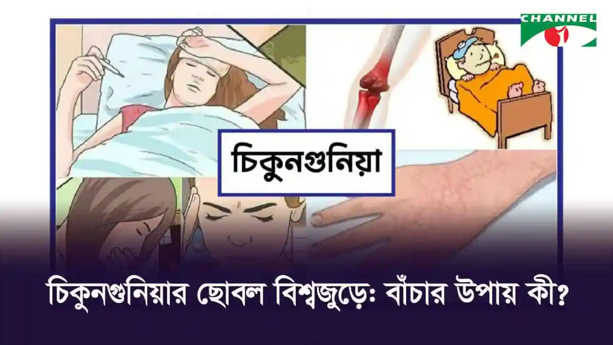চিকুনগুনিয়া রোগের লক্ষণ ও উপসর্গ দেখাচ্ছে শিশু ও বয়স্ক. Channel i News - চ্যানেল আই নিউজ