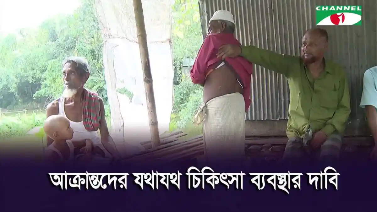 রংপুরে অ্যানথ্রাক্স রোগে আক্রান্ত ব্যক্তির চিকিৎসা চলমান. Channel i News - চ্যানেল আই নিউজ