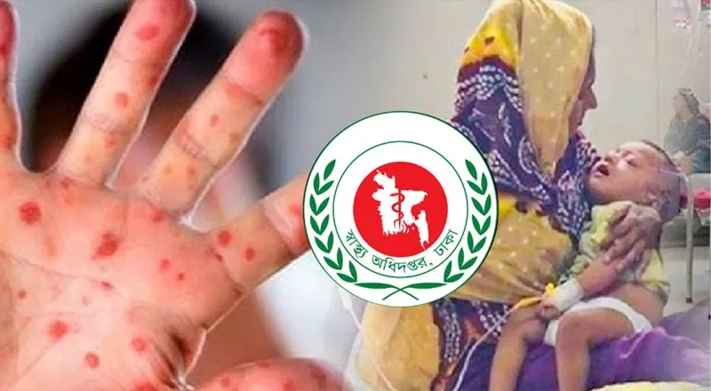 এখন পর্যন্ত হাম ও হামের উপসর্গে ৪৫৩ শিশুর মৃত্যু