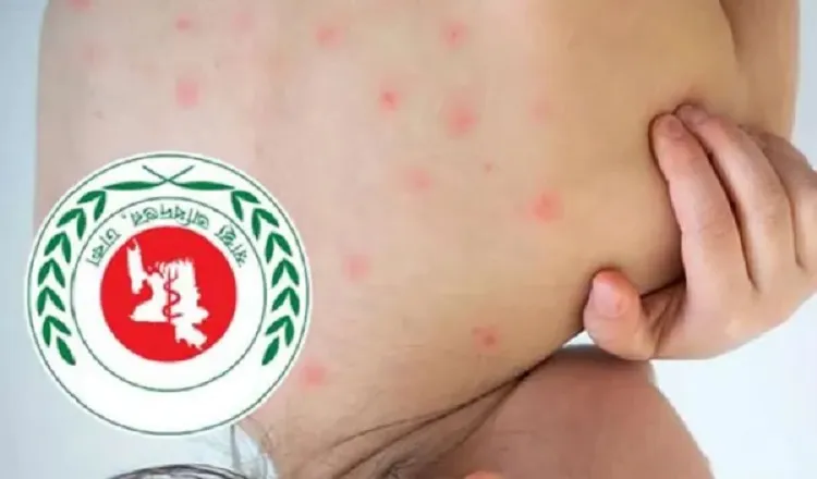 দেশে হামে মৃত্যুর সংখ্যা ছাড়াল ১১০০